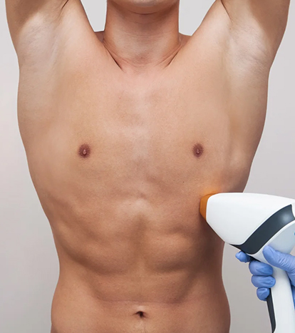 Tüm Vücut Lazer Epilasyon